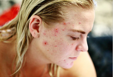 Acné hormonale : comment la reconnaître et la traiter sans agresser sa peau ?