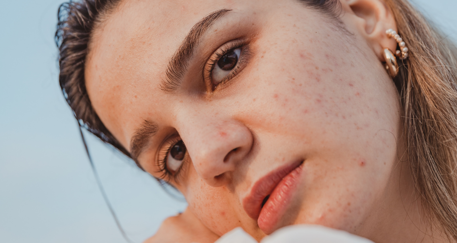 Effet rebond après l’été : pourquoi les boutons reviennent toujours à la rentrée ?