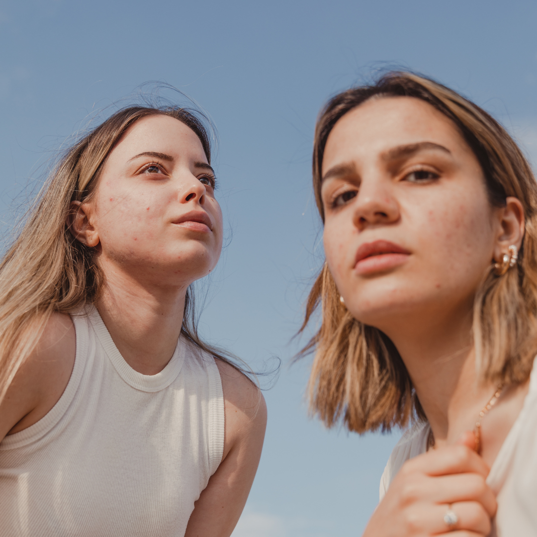 Acné adulte vs acné adolescente : quelles différences ?